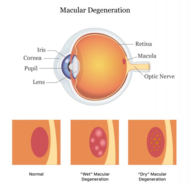 Wet vs. dry macular degeneration