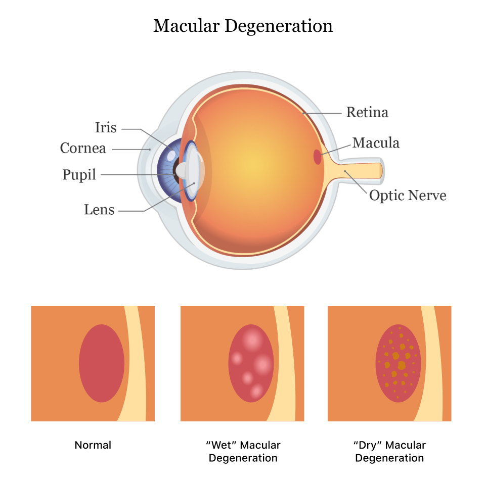 Maculopathy Vision Losacular