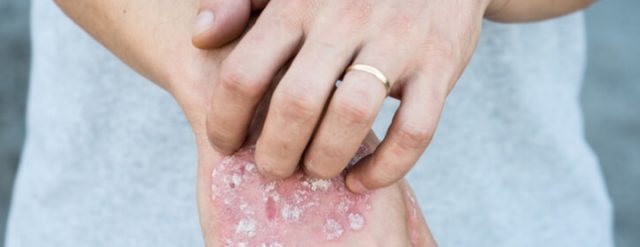 Man with psoriasis on his hand