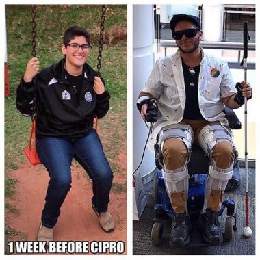 Mateo Rojas before and after Cipro