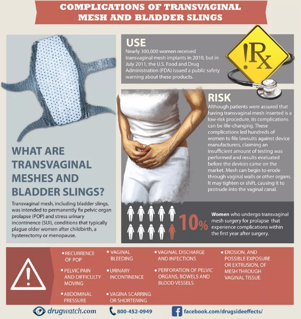 Transvaginal Mesh & Bladder Sling Complications Infographic