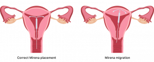 Illustration of Mirena migration
