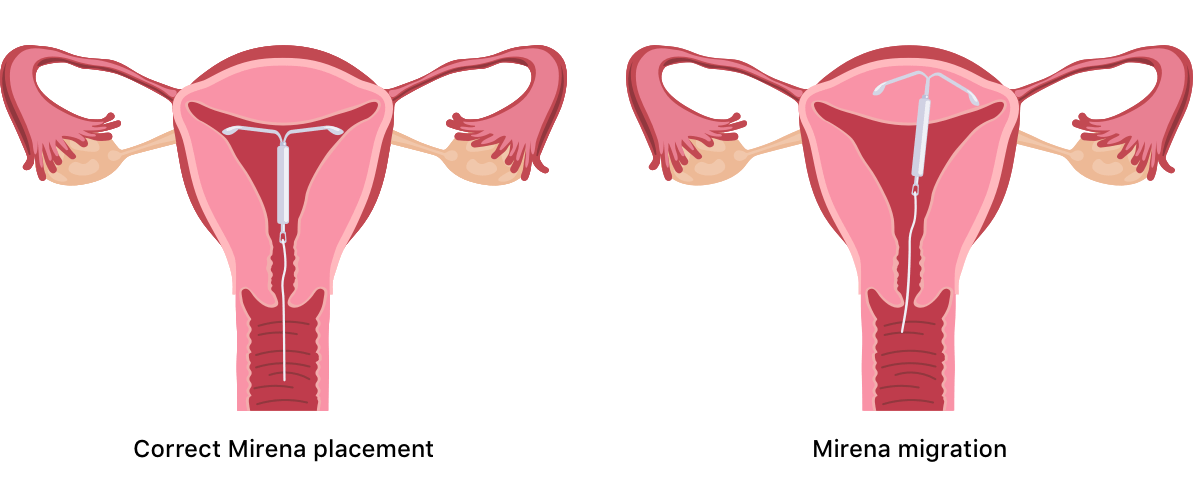 Illustration of Mirena migration