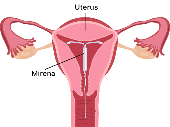 Mirena Placement Diagram