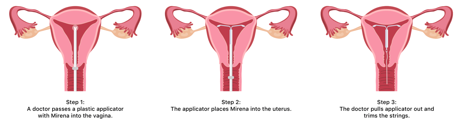 Mirena Insertion What To Expect With Mirena Iud Placement