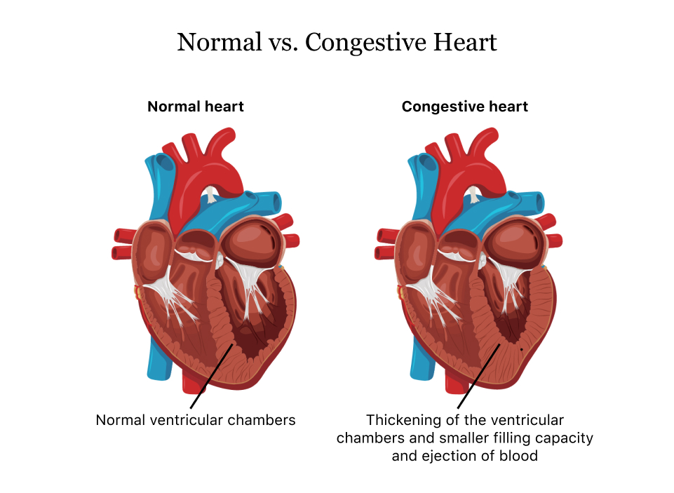 Congestive Heart Failure | Types, Symptoms, and Treatment