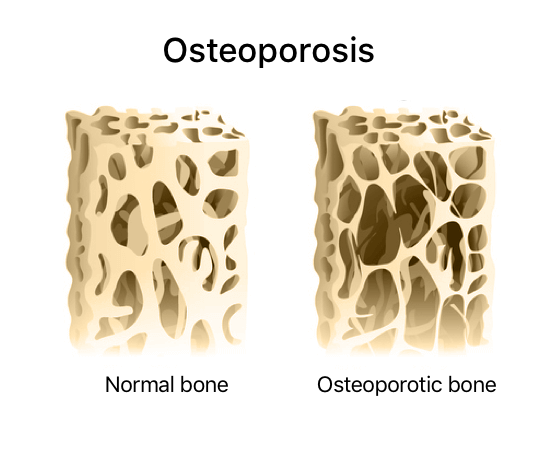 Normal bone density and osteoporotic bone loss