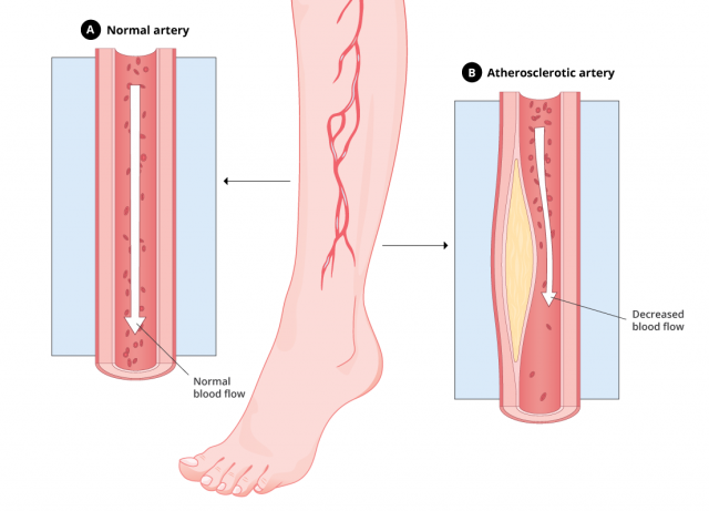 Graphic that compares a normal artery versus an atherosclerotic artery