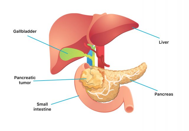 Diagram of pancreatic cancer