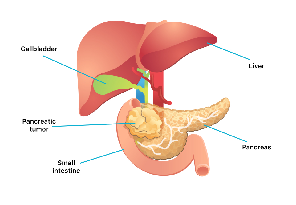 mesothelioma pulmonary function