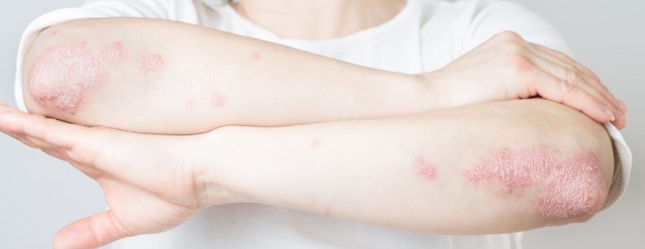 Person with psoriasis