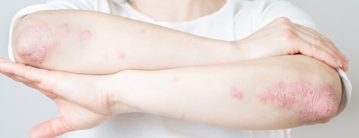 Person with psoriasis