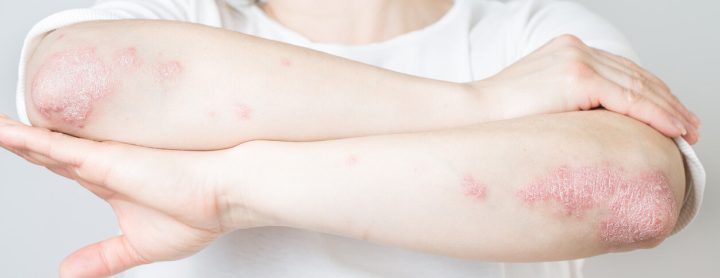 otezla psoriasis treatment