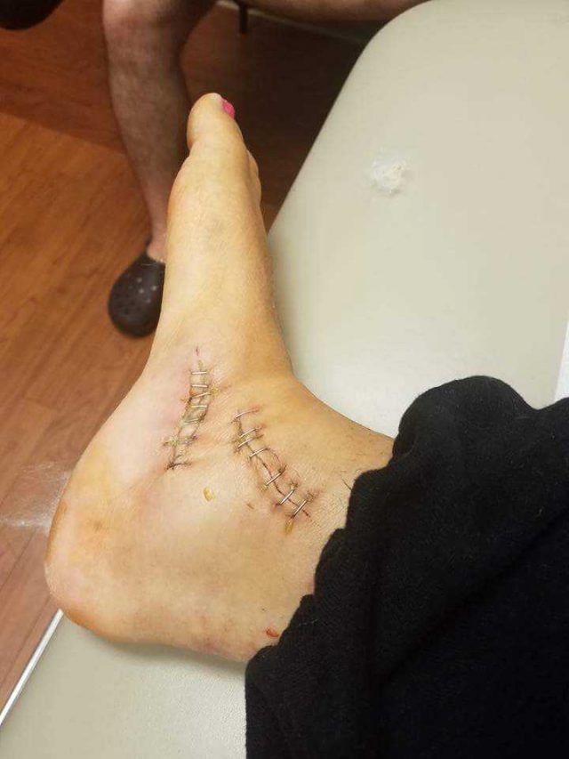 Rachel Brummert Ankle Staples