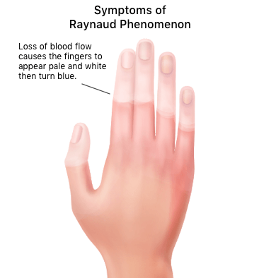Illustration of loss of blood in hand due to Raynaud's Phenomenon.