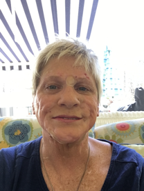 Anne Scott after procedure