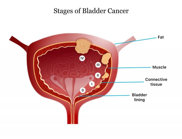Stages of bladder cancer diagram
