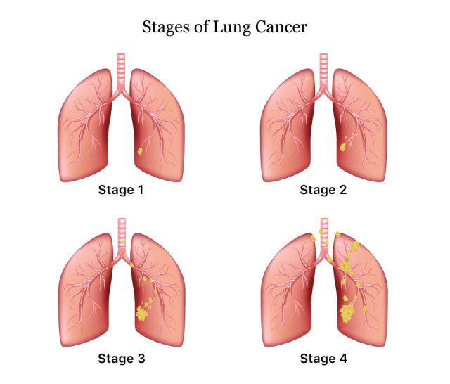 The four stages of lung cancer