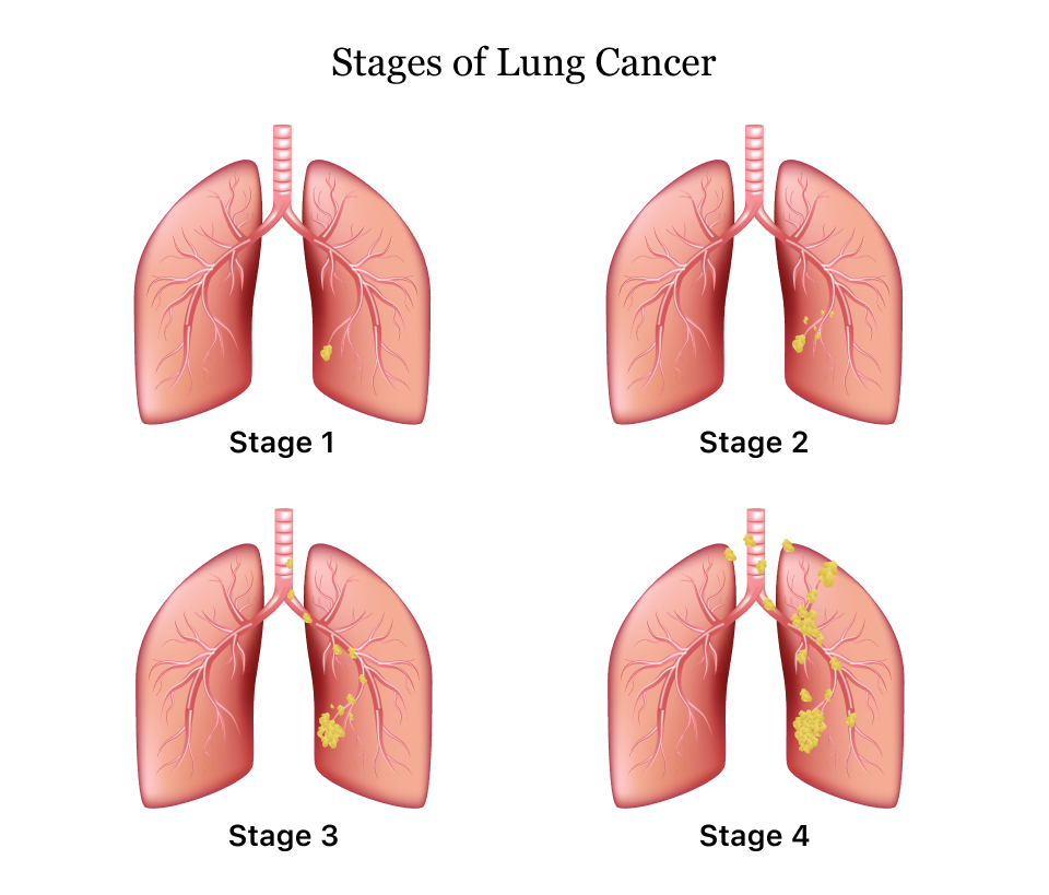 nursing diagnosis for copd exacerbation