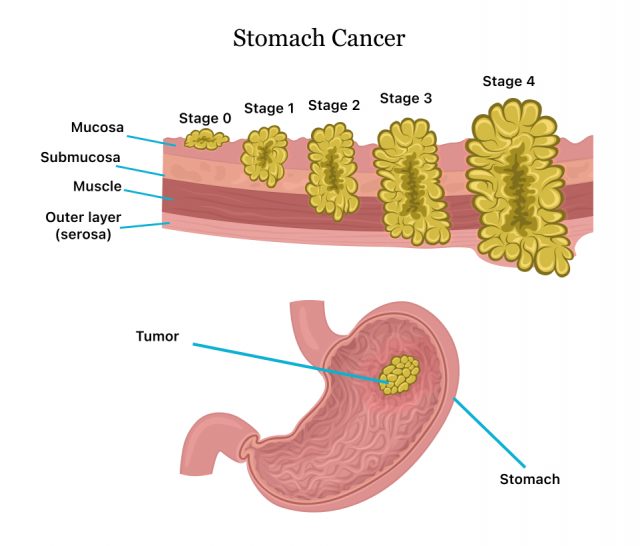 research paper on stomach cancer