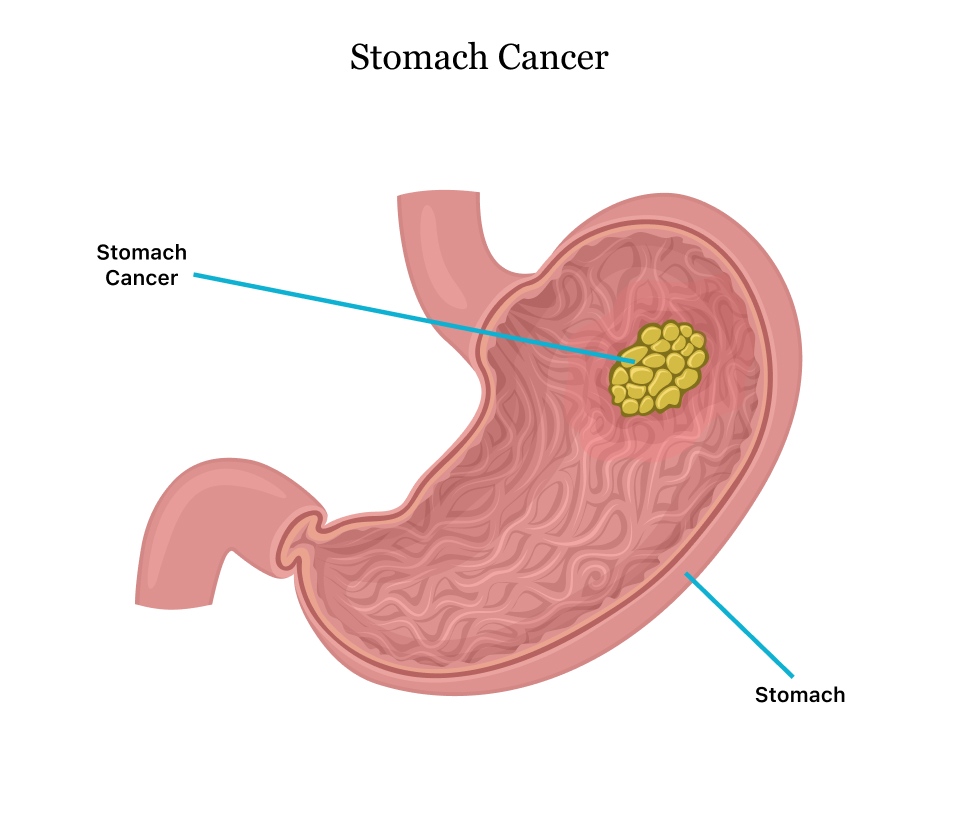 Gastric cancer pain
