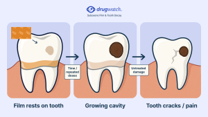 Three-panel illustration shows Suboxone film resting on a healthy tooth, cavity enlarging over time, and untreated damage leading to a cracked, painful tooth.