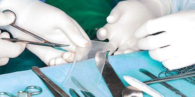 Surgical mesh being handled by surgeons