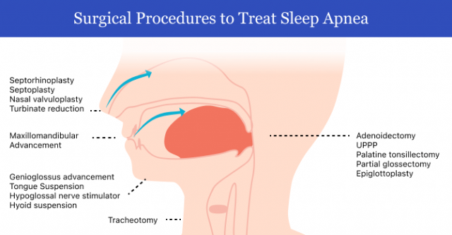 surgical procedures to treat sleep apnea