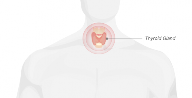 Inflamed thyroid gland