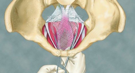 Transvaginal Mesh over 3d pelvic bone model