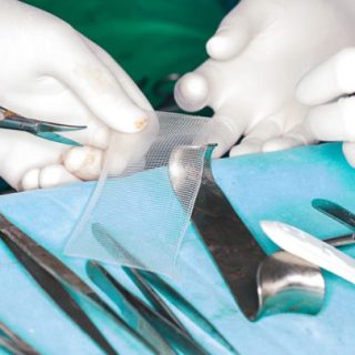 Transvaginal mesh
