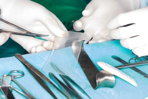 Transvaginal mesh