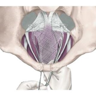 Illustration of Transvaginal Mesh procedure
