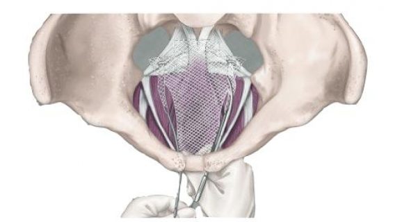 Illustration of Transvaginal Mesh procedure