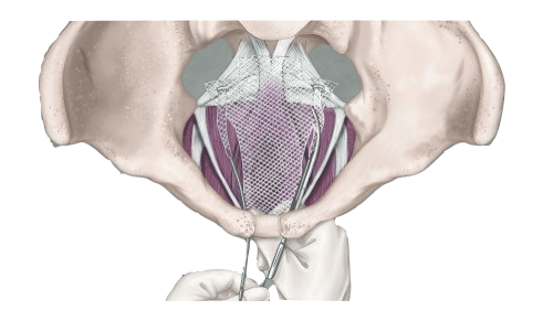 Illustration of Transvaginal Mesh procedure