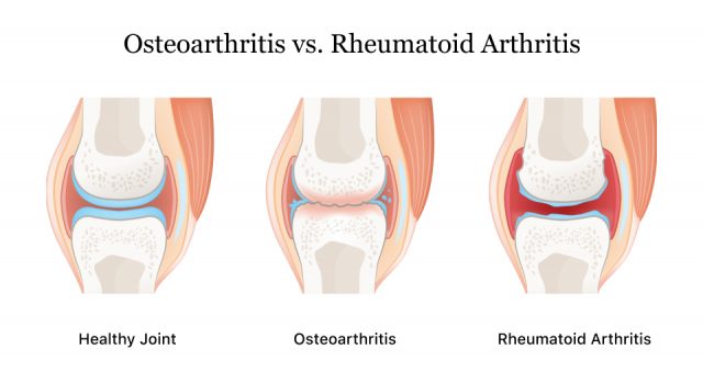 Osteoarthritis vs. Rheumatoid Arthritis