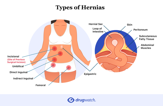 Hiatal Hernia Surgery: Recovery, Scars, and More