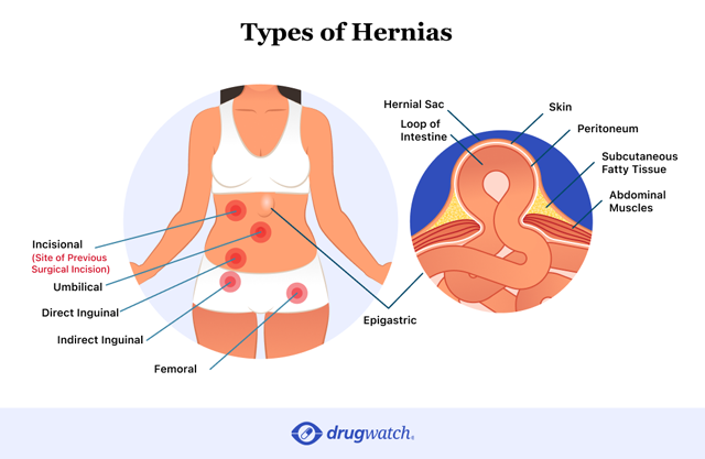 Umbilical Hernia: Its Complications and Treatment