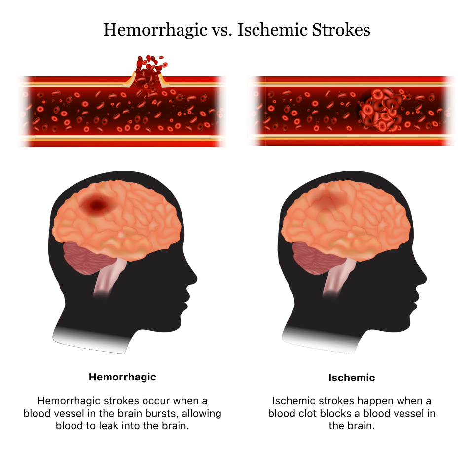 Different Types Of Strokes