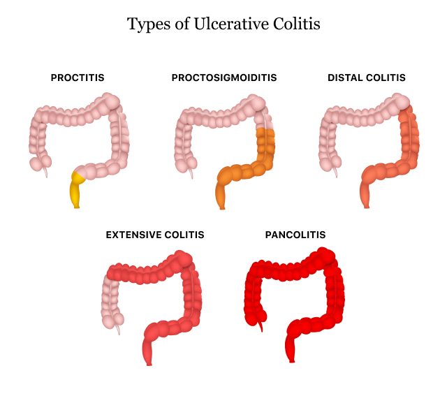 Types of Ulcerative Colitis