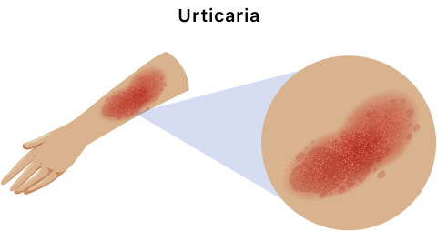 Allergic reaction, urticaria.