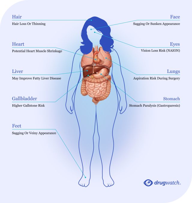 Illustration of a human body showing the potential effects of Ozempic on different organs and areas.