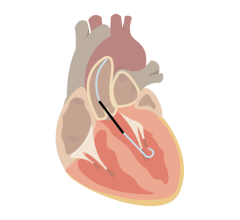 Abiomed Impella Heart Pump