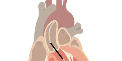Abiomed Impella Heart Pump