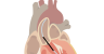 Abiomed Impella Heart Pump