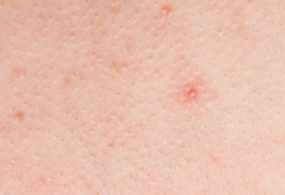 Close up shot of acne skin