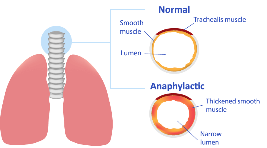Anaphylaxis Swelling Diagram