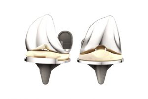 Knee Replacement