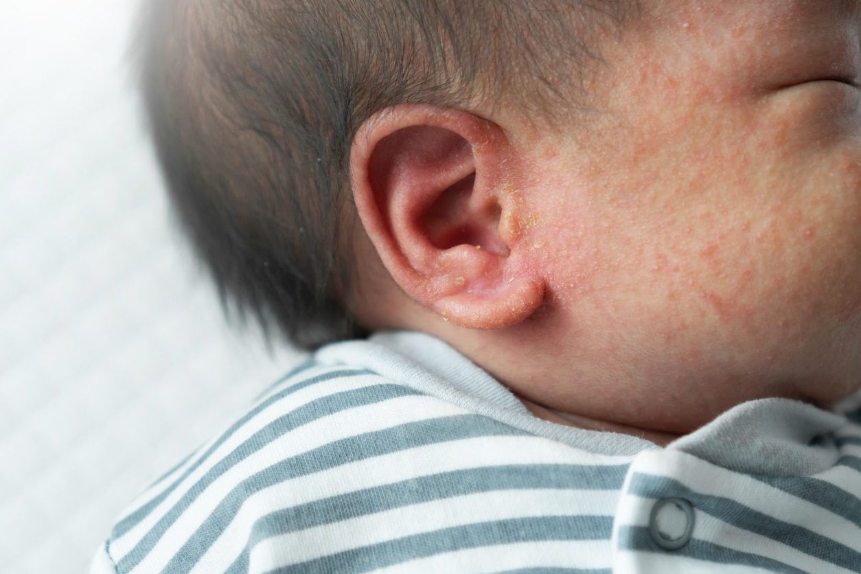 Baby Eczema: Symptoms, Treatment, Causes & Does Your Baby Have It?
