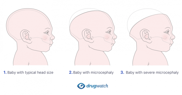 microcephaly illustration